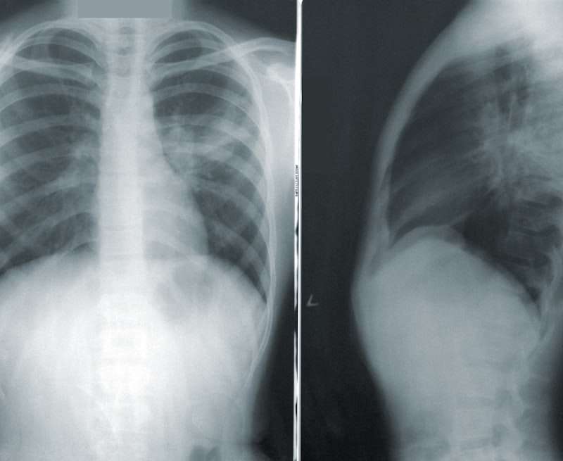 Plaučių uždegimas (pneumonija) – pavojinga infekcija. Simptomai, kuo skiriasi nuo bronchito, gydymas ir kada būtina hospitalizacija.
